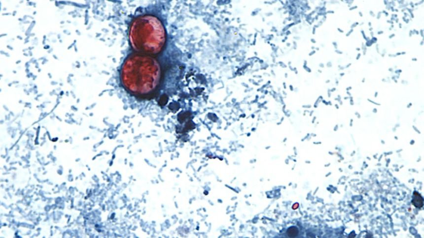 Cyclosporiasis is an intestinal infection caused by the parasite Cyclospora cayetanensis. This is seen here on a stool sample through a microscope on a glass slide. The parasite is too small to be seen without the use of a microscope. The disease occurs as a result of eating food or drink containing the parasite, and a person usually becomes ill within about a week.