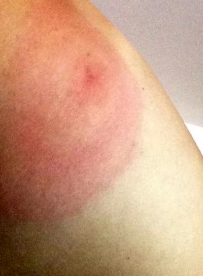 Farmer bitten twice by ticks carrying Lyme disease 14 Target erythema migrans is characteristic of a tick bite. Photo by Line Bellemare
